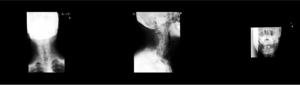 ２０２２首（頚椎 cervical spine）インデックス