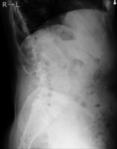 骨盤と背骨（L5椎骨とS1～5仙骨）側面４５度撮影2022