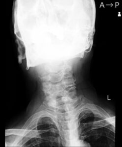 2023首回りの頸椎（７個） 正面