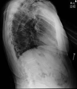 脊椎胸骨（T6,7椎骨）側面立位